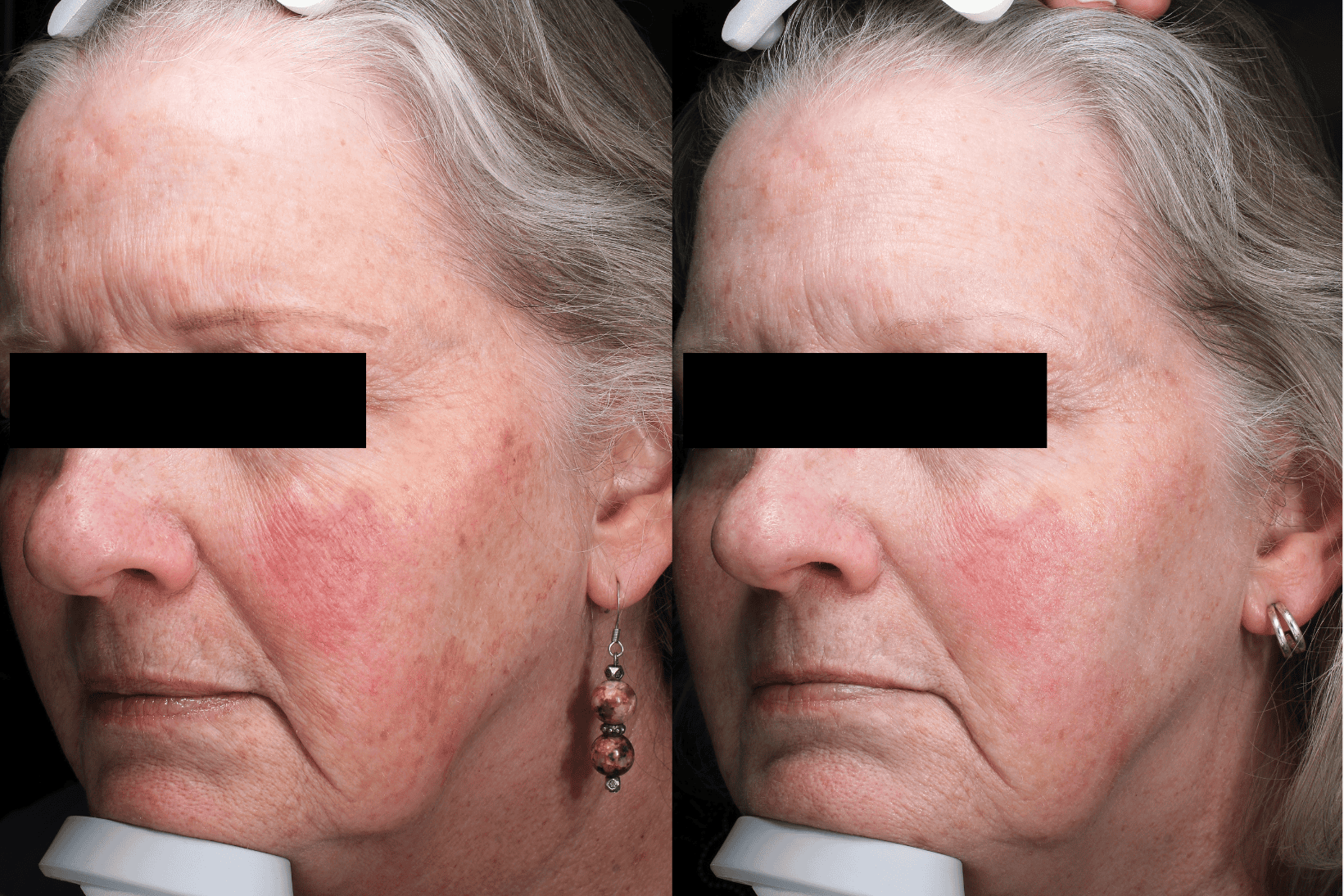 SaltFacial 8 - Ducharme Dermatology